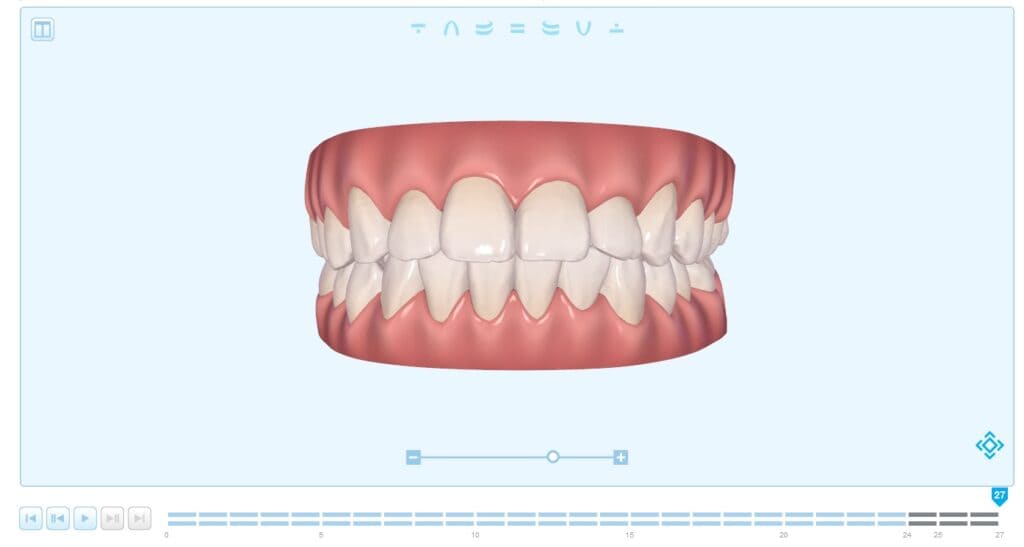 クリンチェック(治療計画シミュレーション)確認 【約3週間後】