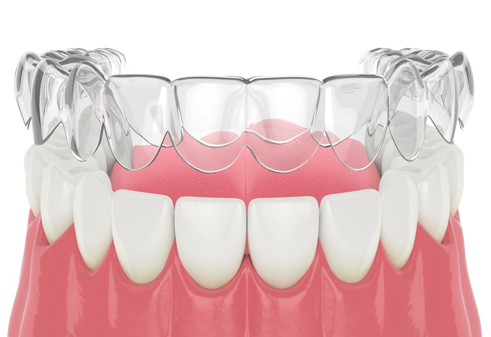 マウスピース型矯正装置(インビザライン)治療開始